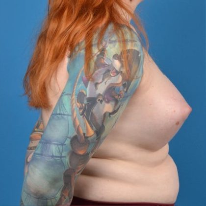 Transgender Surgery (MTF) Before & After Patient #1268