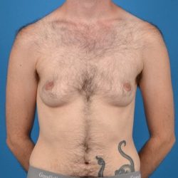 Transgender Surgery (FTM) Before & After Patient #1267