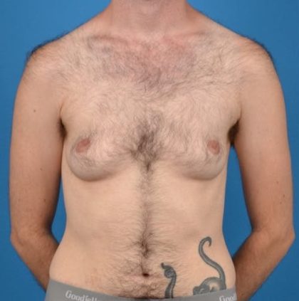 Transgender Surgery (FTM) Before & After Patient #1267