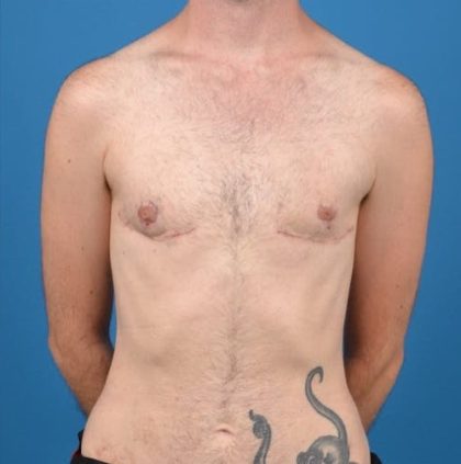 Transgender Surgery (FTM) Before & After Patient #1267