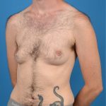Transgender Surgery (FTM) Before & After Patient #1267
