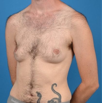 Transgender Surgery (FTM) Before & After Patient #1267