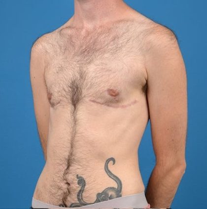 Transgender Surgery (FTM) Before & After Patient #1267