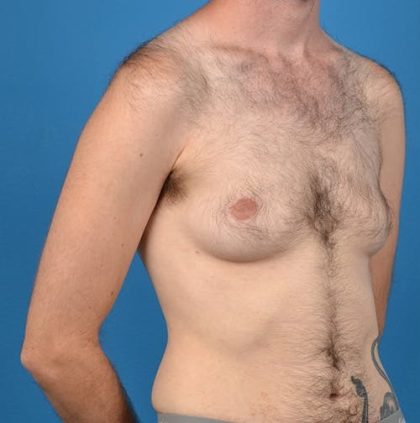 Transgender Surgery (FTM) Before & After Patient #1267