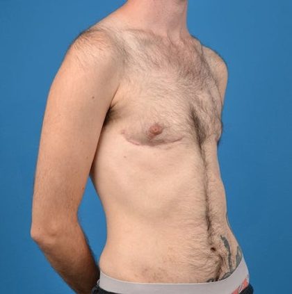 Transgender Surgery (FTM) Before & After Patient #1267
