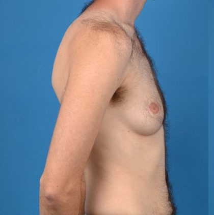 Transgender Surgery (FTM) Before & After Patient #1267