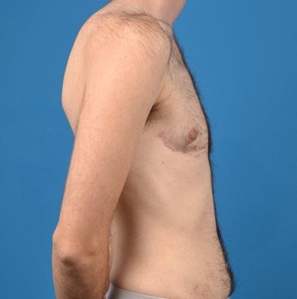 Transgender Surgery (FTM) Before & After Patient #1267