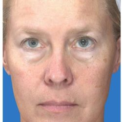 Under Eye Filler Before & After Patient #1335