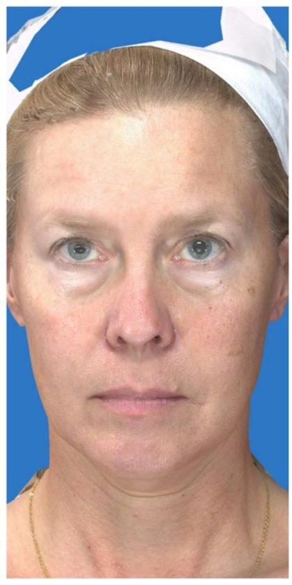 Under Eye Filler Before & After Patient #1335