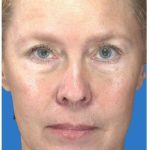 Under Eye Filler Before & After Patient #1335