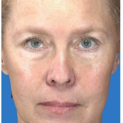Under Eye Filler Before & After Patient #1335