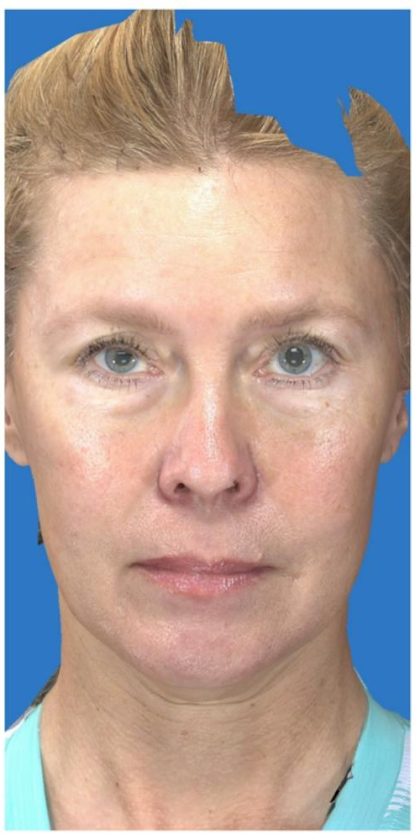 Under Eye Filler Before & After Patient #1335