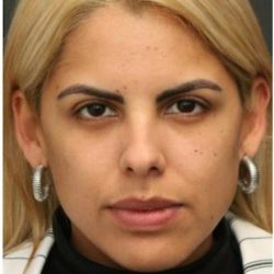Under Eye Filler Before & After Patient #1334