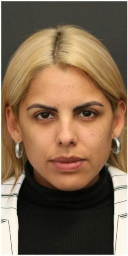 Under Eye Filler Before & After Patient #1334