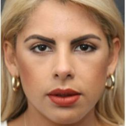 Under Eye Filler Before & After Patient #1334