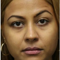 Under Eye Filler Before & After Patient #1333