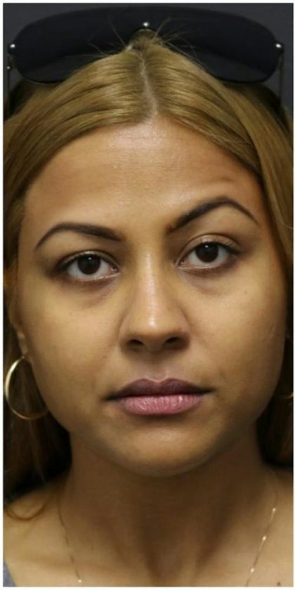 Under Eye Filler Before & After Patient #1333