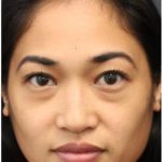 Under Eye Filler Before & After Patient #1332