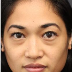 Under Eye Filler Before & After Patient #1332