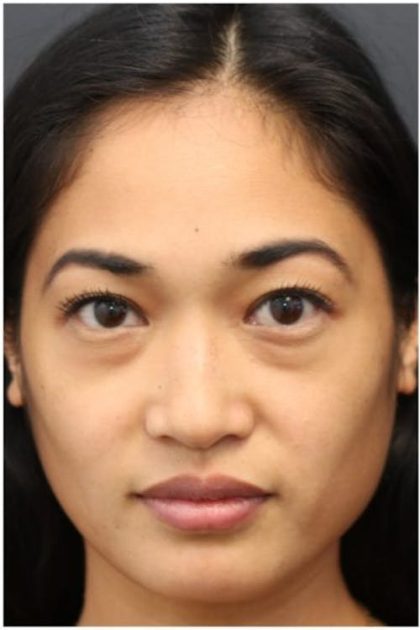 Under Eye Filler Before & After Patient #1332