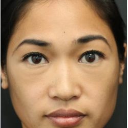 Under Eye Filler Before & After Patient #1332