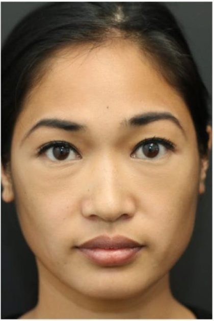 Under Eye Filler Before & After Patient #1332