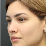 Under Eye Filler Before & After Patient #1331