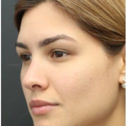 Under Eye Filler Before & After Patient #1331