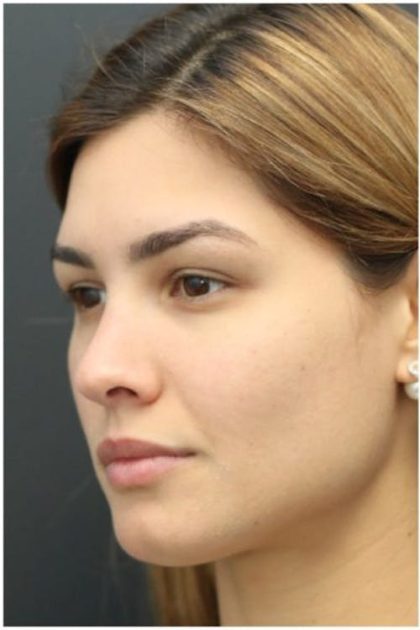 Under Eye Filler Before & After Patient #1331