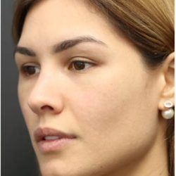 Under Eye Filler Before & After Patient #1331