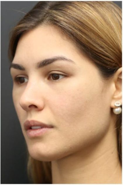 Under Eye Filler Before & After Patient #1331