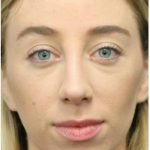 Under Eye Filler Before & After Patient #1330