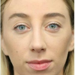 Under Eye Filler Before & After Patient #1330