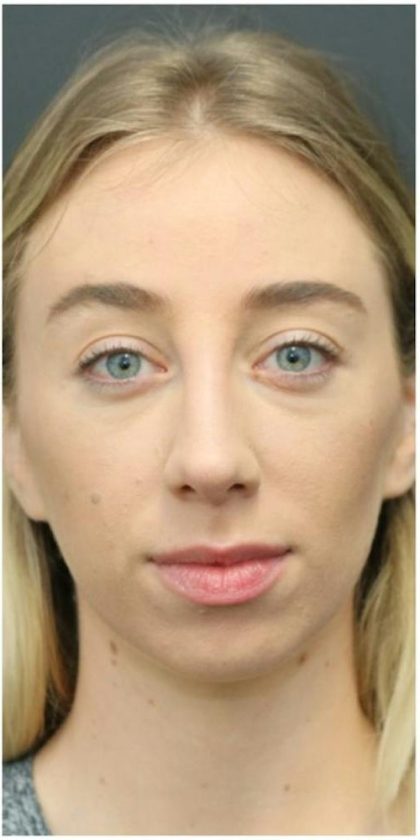 Under Eye Filler Before & After Patient #1330