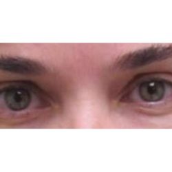 Eyelid Surgery Before & After Patient #1169