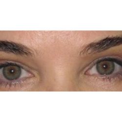 Eyelid Surgery Before & After Patient #1169