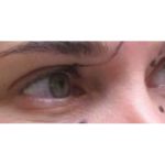 Eyelid Surgery Before & After Patient #1169