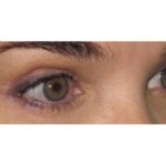 Eyelid Surgery Before & After Patient #1169