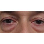 Eyelid Surgery Before & After Patient #1174