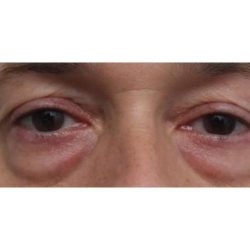Eyelid Surgery Before & After Patient #1174