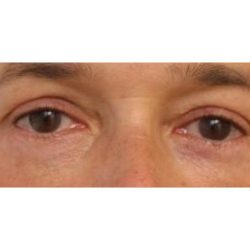 Eyelid Surgery Before & After Patient #1174