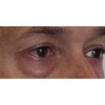 Eyelid Surgery Before & After Patient #1174