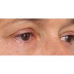 Eyelid Surgery Before & After Patient #1174