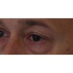 Eyelid Surgery Before & After Patient #1174
