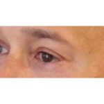 Eyelid Surgery Before & After Patient #1174