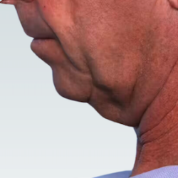 Facelift Before & After Patient #2842