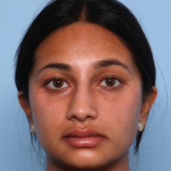 Rhinoplasty Before & After Patient #2808