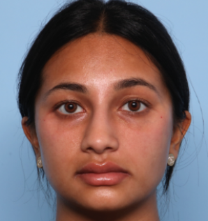 Rhinoplasty Before & After Patient #2808