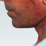 Facelift Before & After Patient #2842