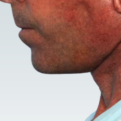 Facelift Before & After Patient #2842